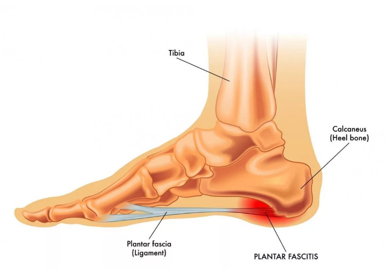 Ilustración anatómica del pie con la fascia plantar y la zona de dolor en el calcáneo