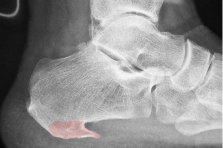 Radiografía lateral del pie con el espolón calcáneo señalado en rojo